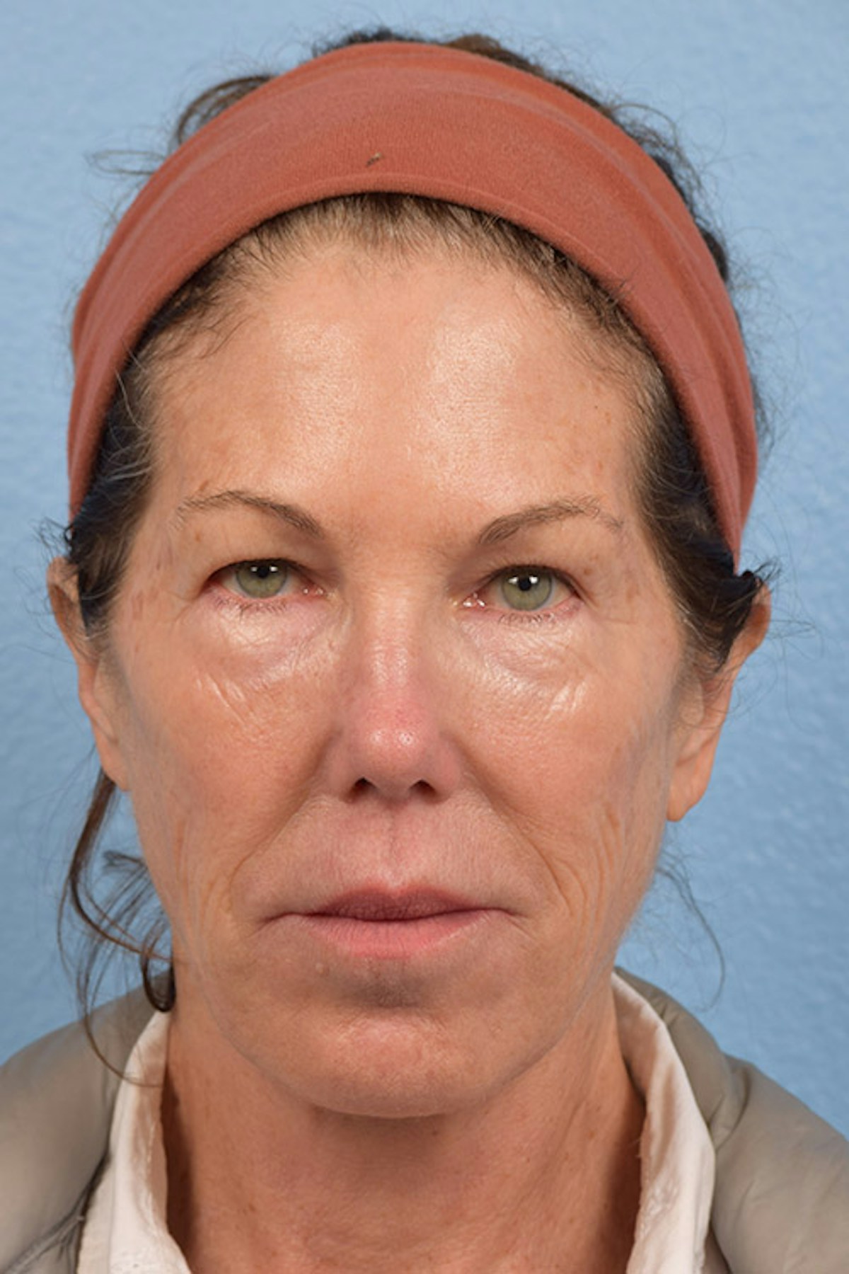 Facial Rejuvenation Before & After Gallery - Patient 880748 - Image 1