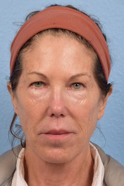 Facial Rejuvenation Before & After Gallery - Patient 880748 - Image 1