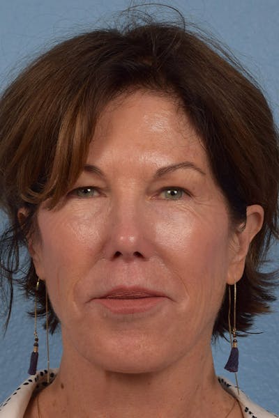 Facial Rejuvenation Before & After Gallery - Patient 880748 - Image 2