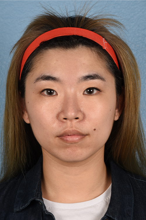 Ultherapy Before & After Gallery - Patient 103120 - Image 1