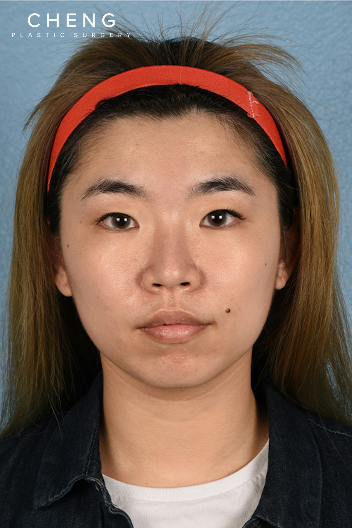 Hidden Patients Before & After Gallery - Patient 181791 - Image 1