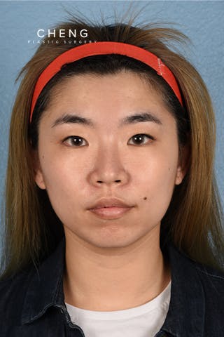 Hidden Patients Before & After Gallery - Patient 181791 - Image 1