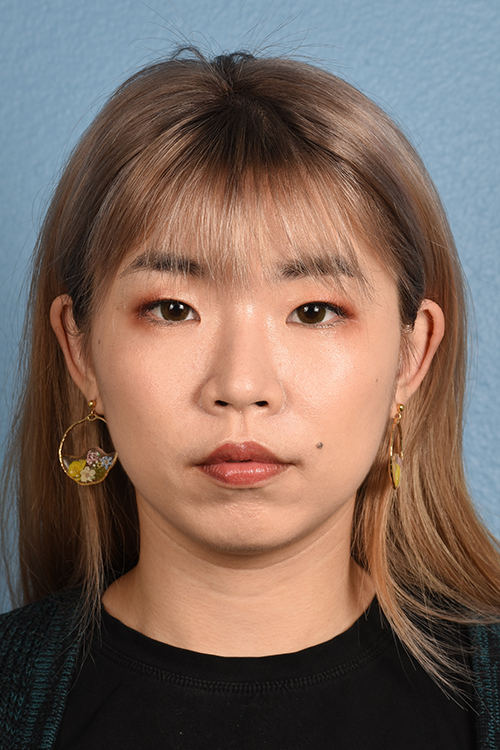 Ultherapy Before & After Gallery - Patient 103120 - Image 2