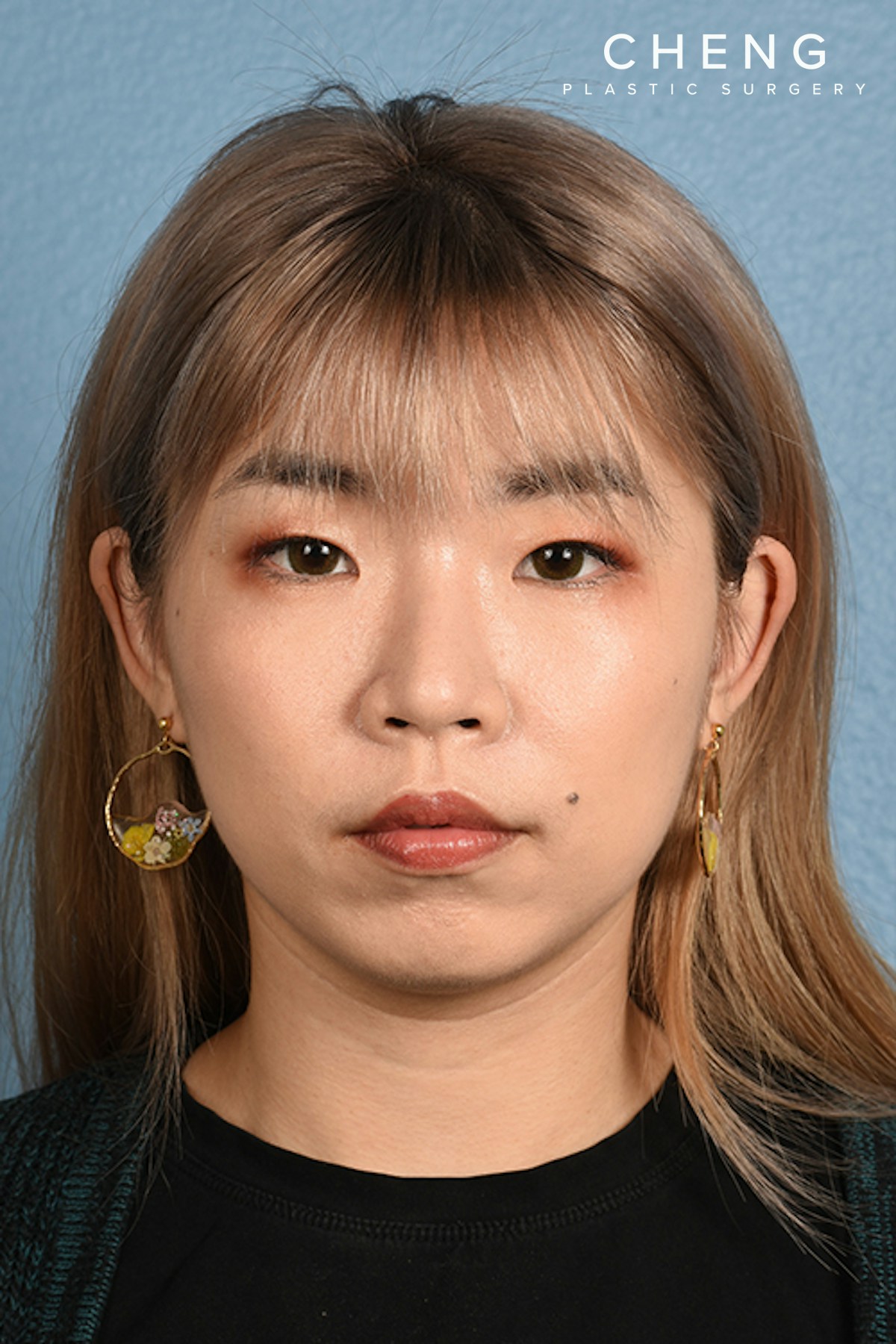 Hidden Patients Before & After Gallery - Patient 181791 - Image 2