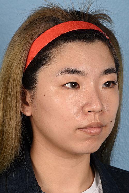 Ultherapy Before & After Gallery - Patient 103120 - Image 3