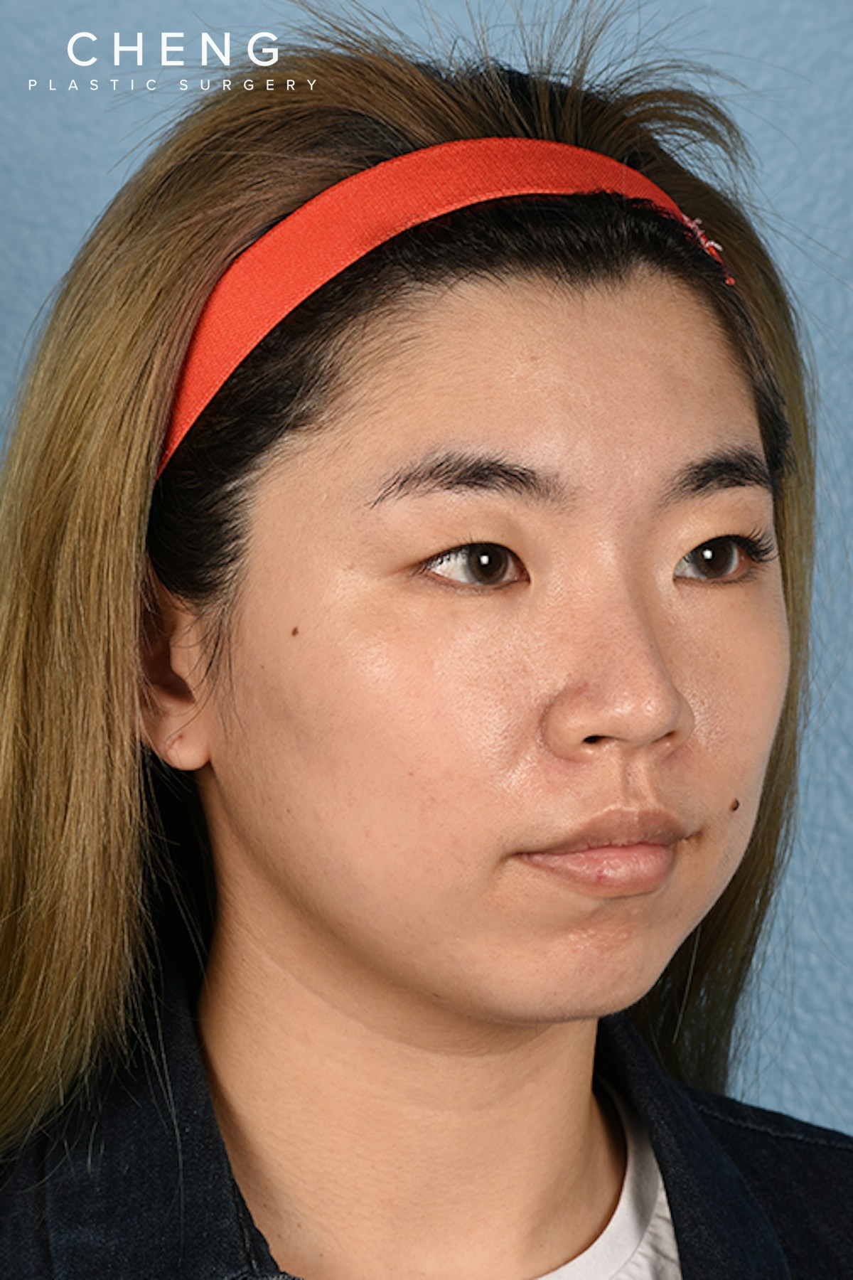 Hidden Patients Before & After Gallery - Patient 181791 - Image 3