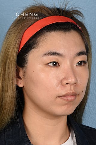 Hidden Patients Before & After Gallery - Patient 181791 - Image 3