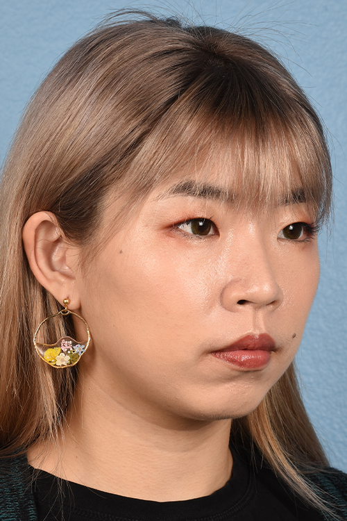 Ultherapy Before & After Gallery - Patient 103120 - Image 4