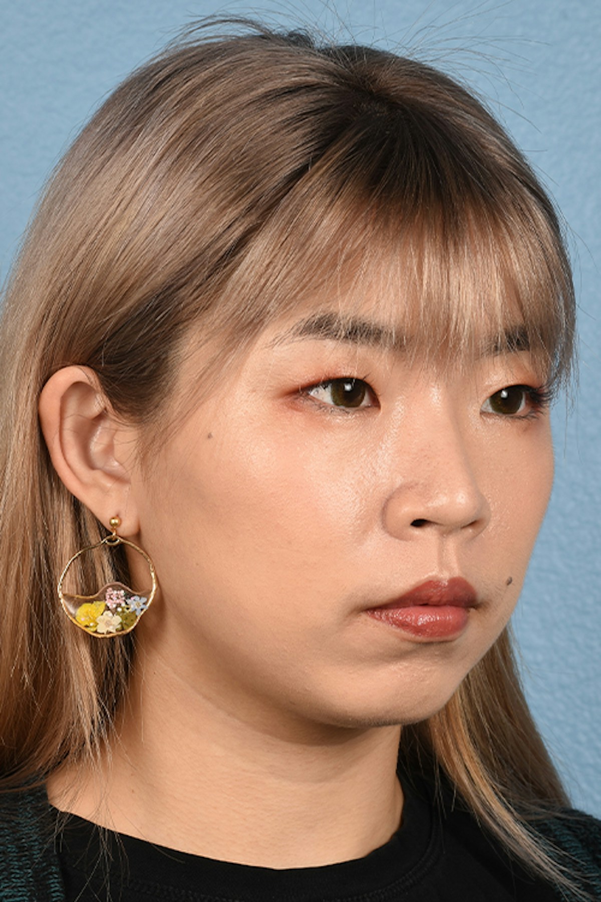 Facial Rejuvenation Before & After Gallery - Patient 103007 - Image 4