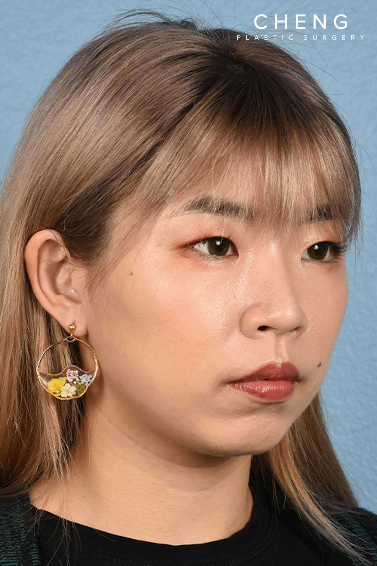 Hidden Patients Before & After Gallery - Patient 181791 - Image 4