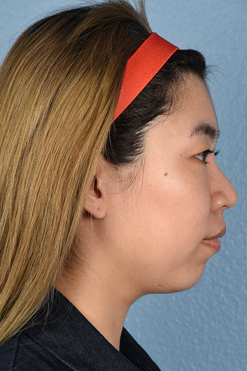 Ultherapy Before & After Gallery - Patient 103120 - Image 5