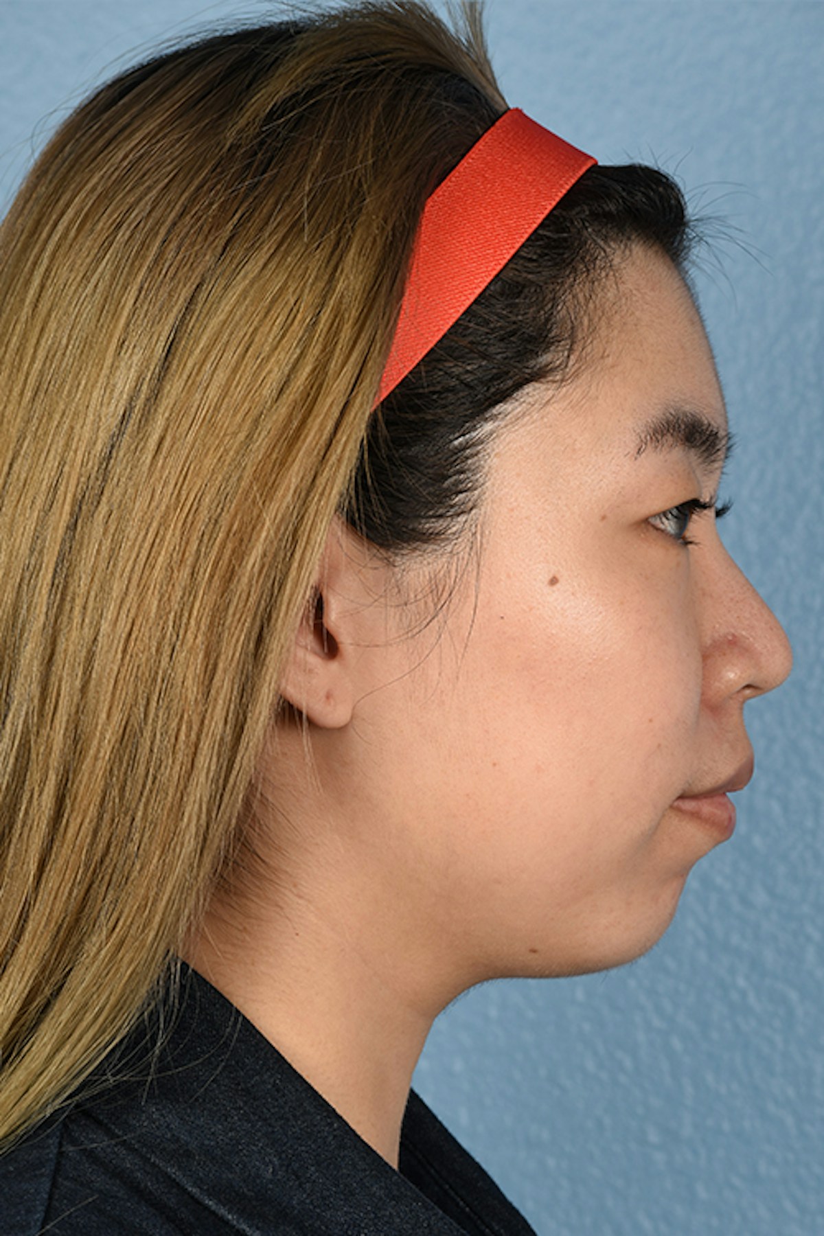 Facial Rejuvenation Before & After Gallery - Patient 103007 - Image 5