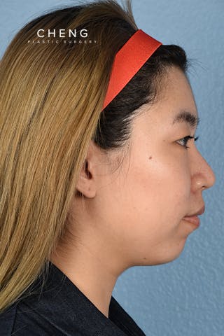 Hidden Patients Before & After Gallery - Patient 181791 - Image 5