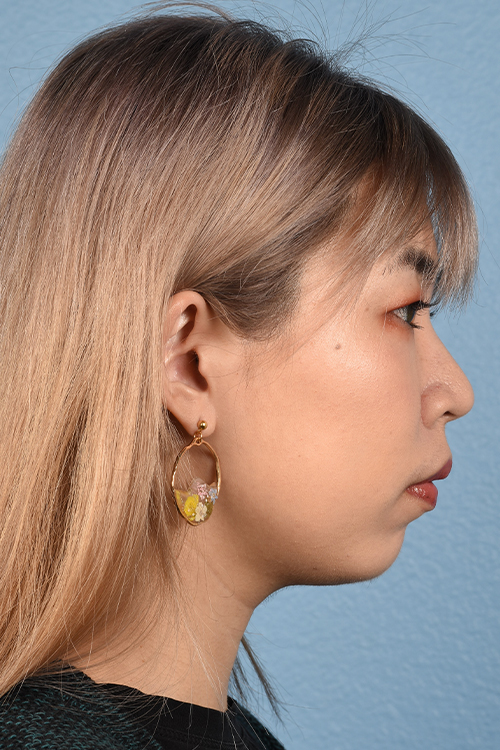 Ultherapy Before & After Gallery - Patient 103120 - Image 6