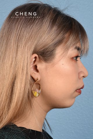 Hidden Patients Before & After Gallery - Patient 181791 - Image 6