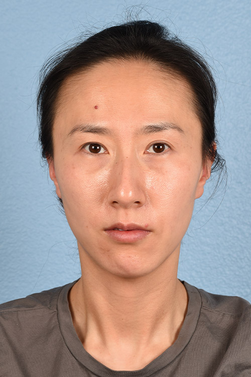 Hidden Patients Before & After Gallery - Patient 128909 - Image 1