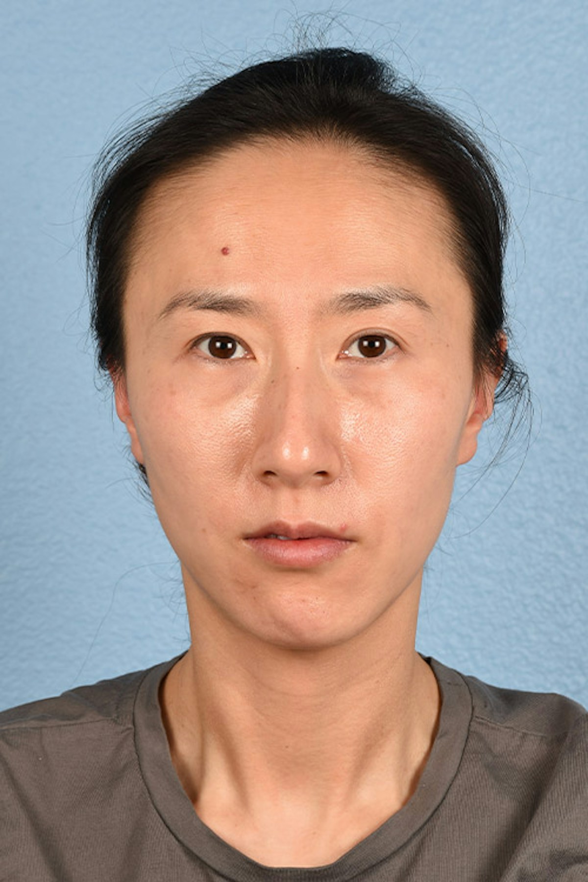 Thermage Flx Before & After Gallery - Patient 179809 - Image 1