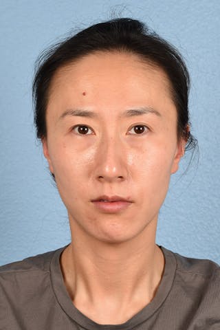 Hidden Patients Before & After Gallery - Patient 128909 - Image 1