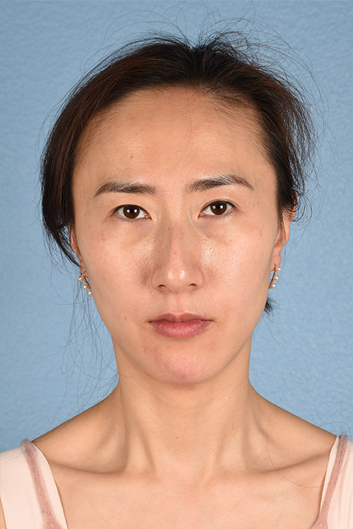 Hidden Patients Before & After Gallery - Patient 128909 - Image 2