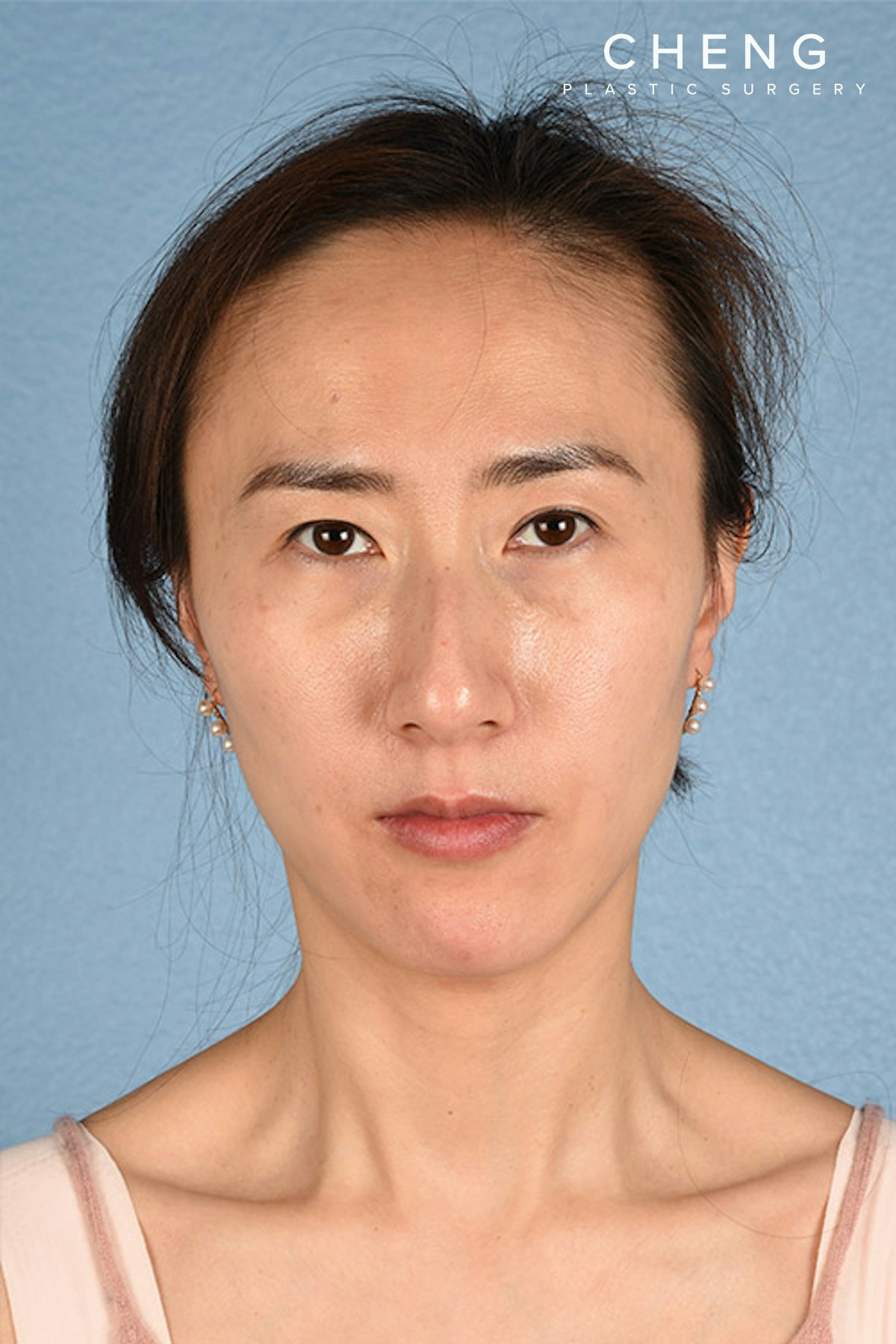 Hidden Patients Before & After Gallery - Patient 128909 - Image 2