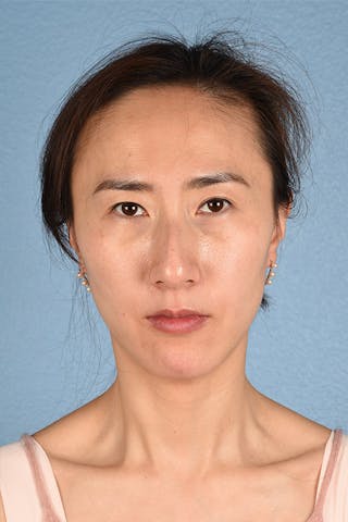 Hidden Patients Before & After Gallery - Patient 128909 - Image 2