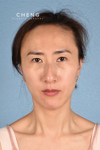 Hidden Patients Before & After Gallery - Patient 128909 - Image 2