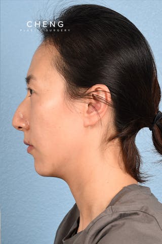 Hidden Patients Before & After Gallery - Patient 128909 - Image 3