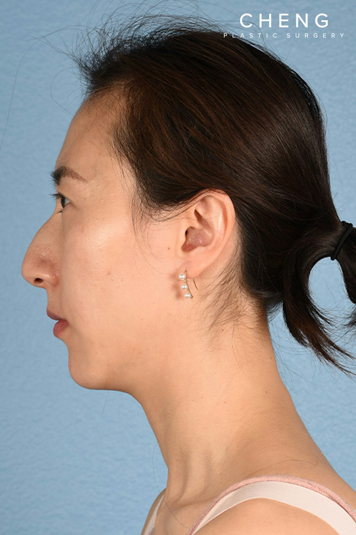 Hidden Patients Before & After Gallery - Patient 128909 - Image 4