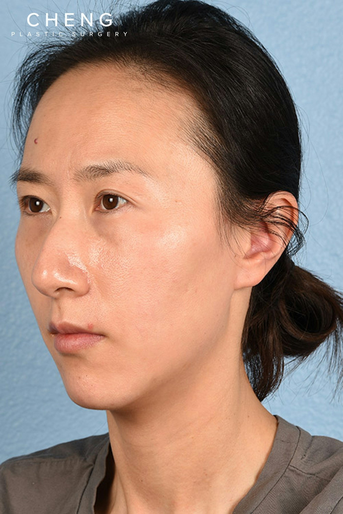 Hidden Patients Before & After Gallery - Patient 128909 - Image 5