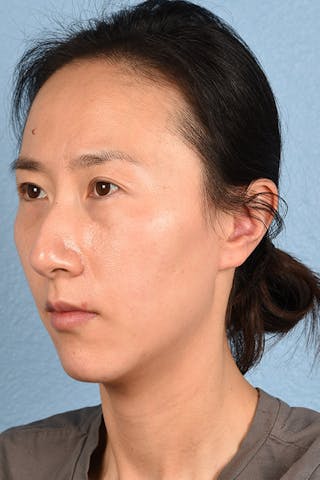 Hidden Patients Before & After Gallery - Patient 128909 - Image 5