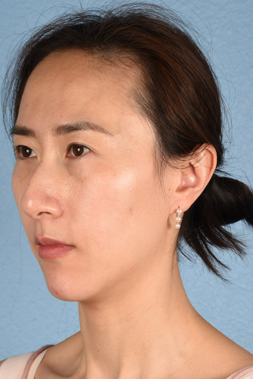 Hidden Patients Before & After Gallery - Patient 128909 - Image 6