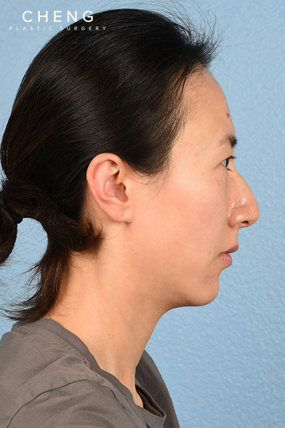 Hidden Patients Before & After Gallery - Patient 128909 - Image 7