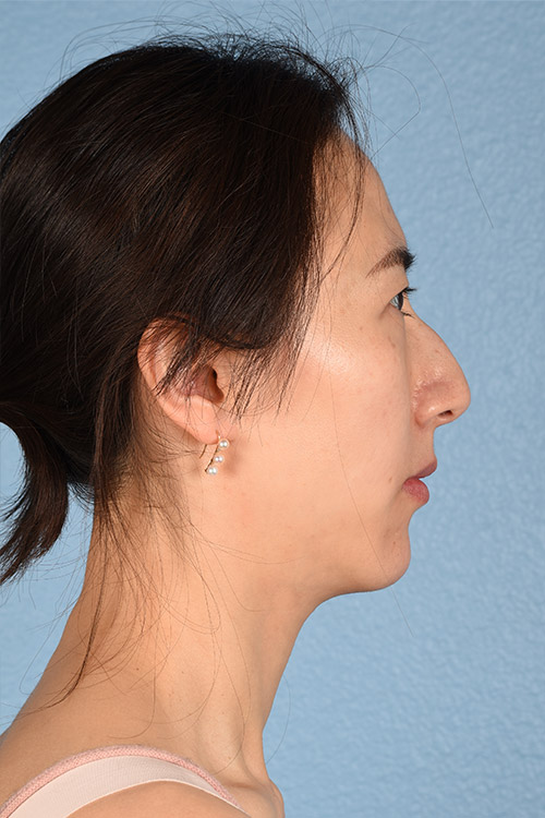 Hidden Patients Before & After Gallery - Patient 128909 - Image 8