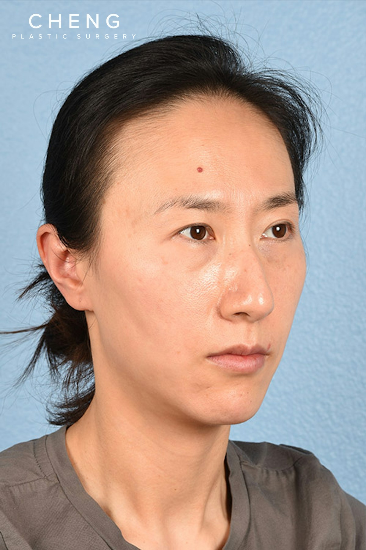 Hidden Patients Before & After Gallery - Patient 128909 - Image 9