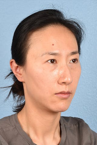 Hidden Patients Before & After Gallery - Patient 128909 - Image 9