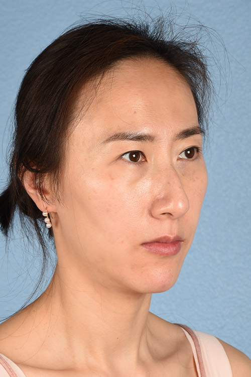 Hidden Patients Before & After Gallery - Patient 128909 - Image 10