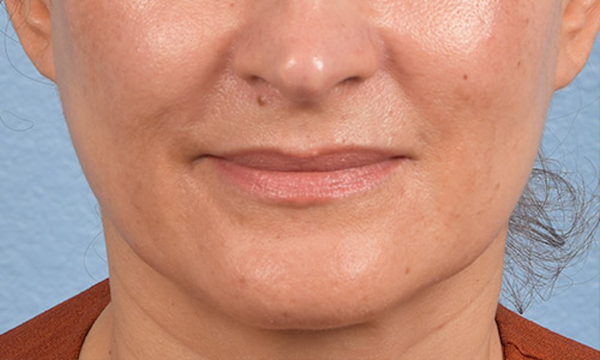 Facial Rejuvenation Before & After Gallery - Patient 403922 - Image 2