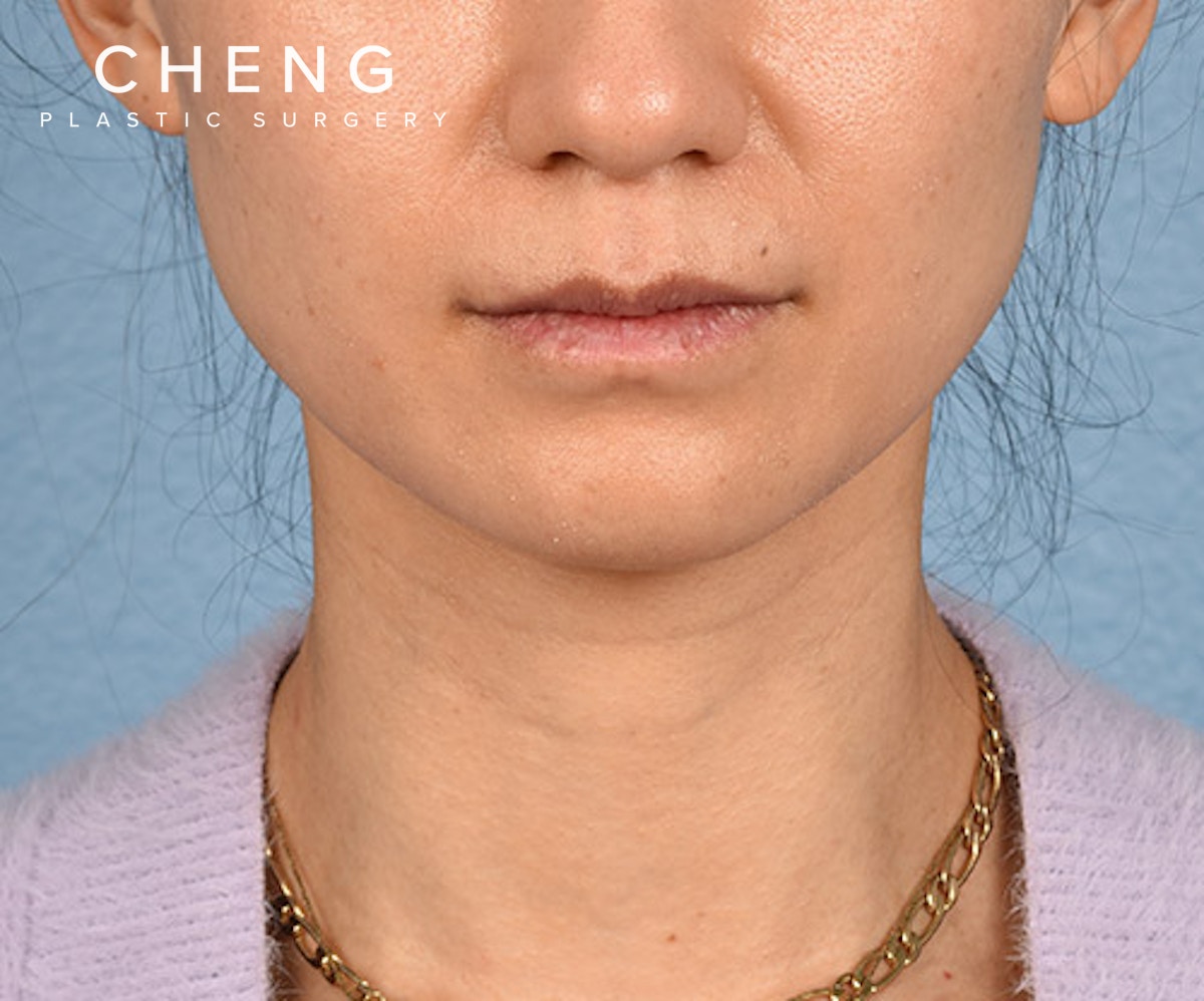 Hidden Patients Before & After Gallery - Patient 343443 - Image 1