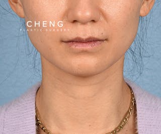 Hidden Patients Before & After Gallery - Patient 343443 - Image 1