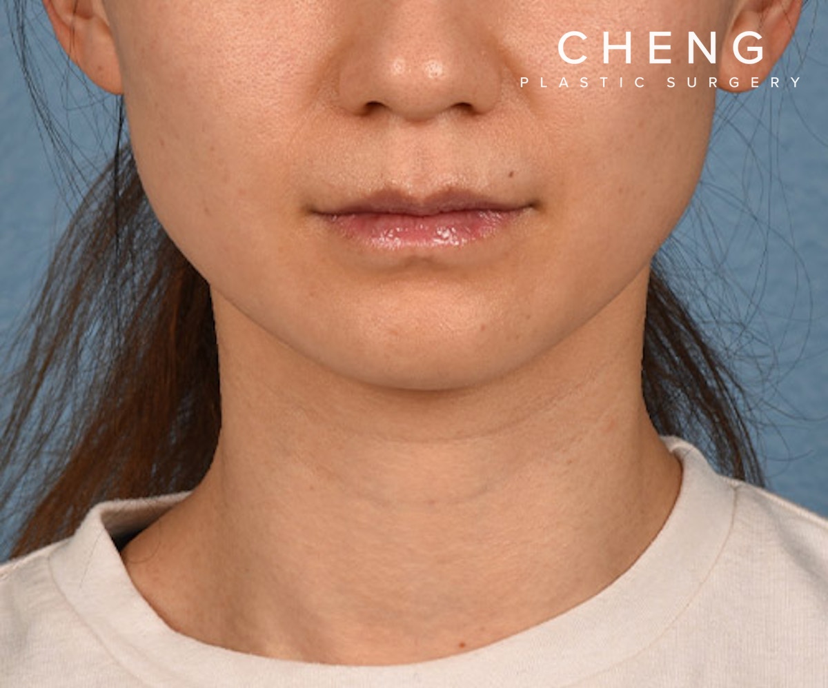 Hidden Patients Before & After Gallery - Patient 343443 - Image 2