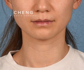 Hidden Patients Before & After Gallery - Patient 343443 - Image 2