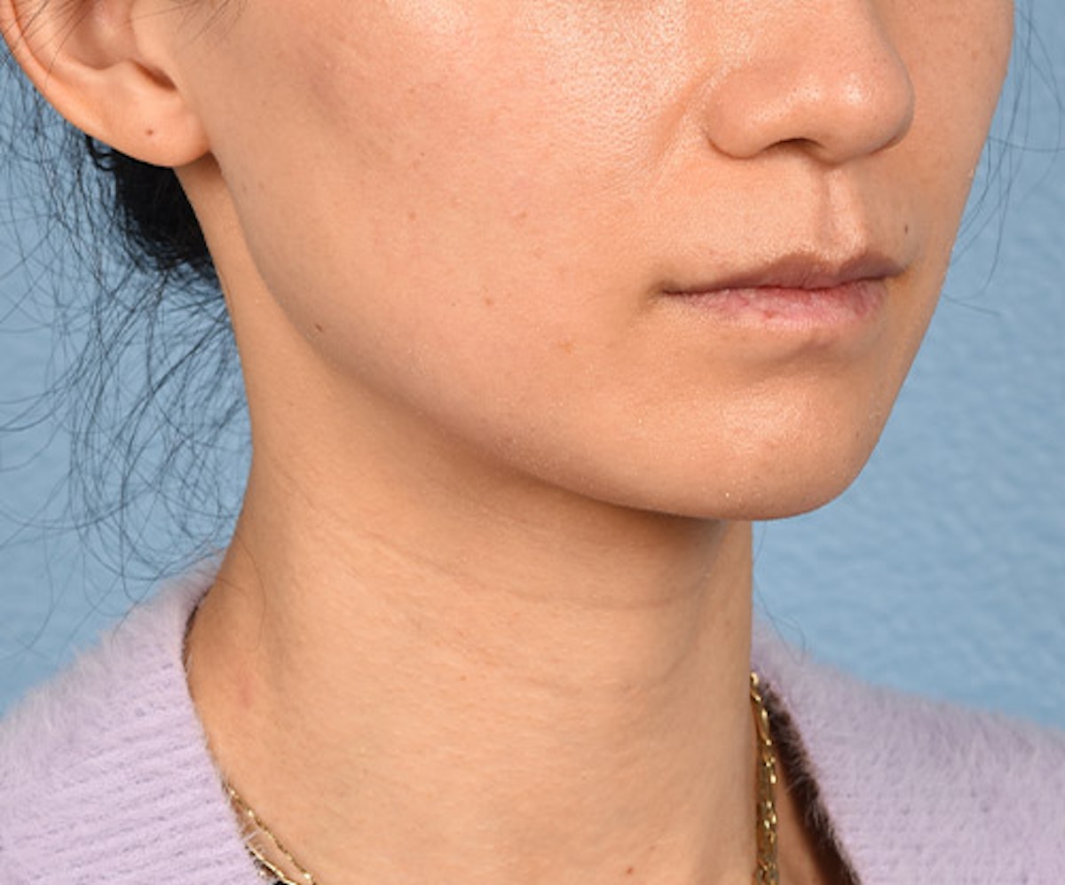 Thermage Flx Before & After Gallery - Patient 219720 - Image 3