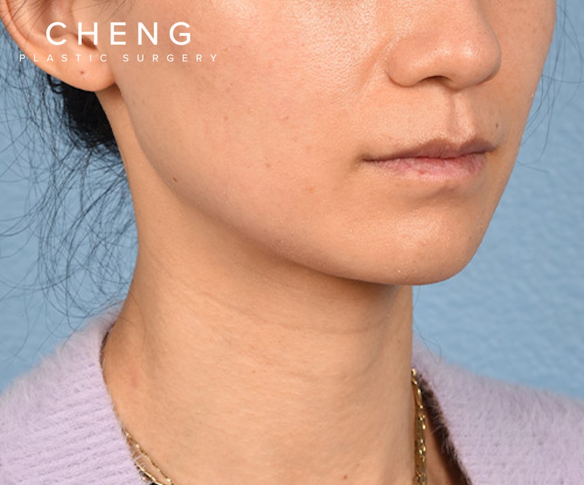 Hidden Patients Before & After Gallery - Patient 343443 - Image 3