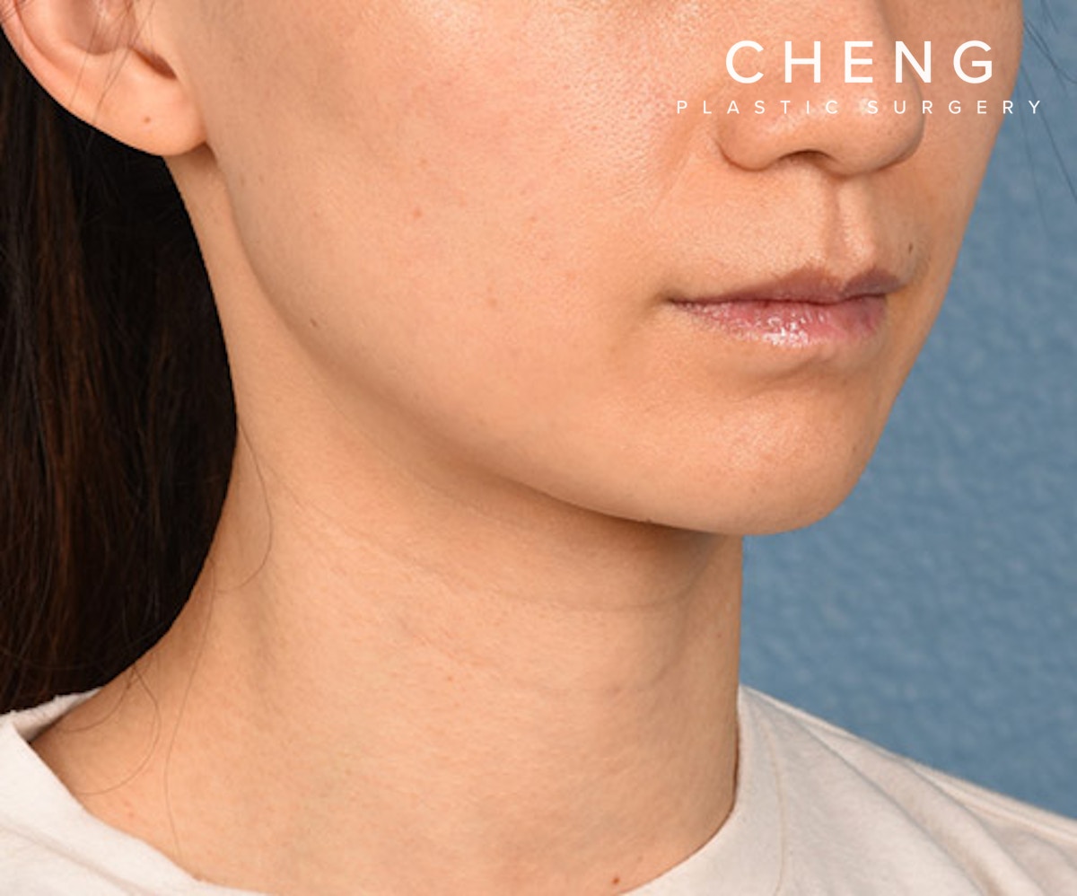 Hidden Patients Before & After Gallery - Patient 343443 - Image 4