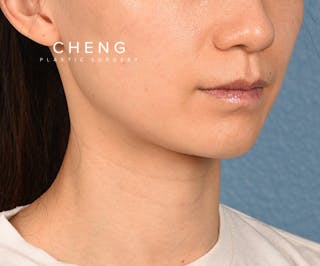 Hidden Patients Before & After Gallery - Patient 343443 - Image 4