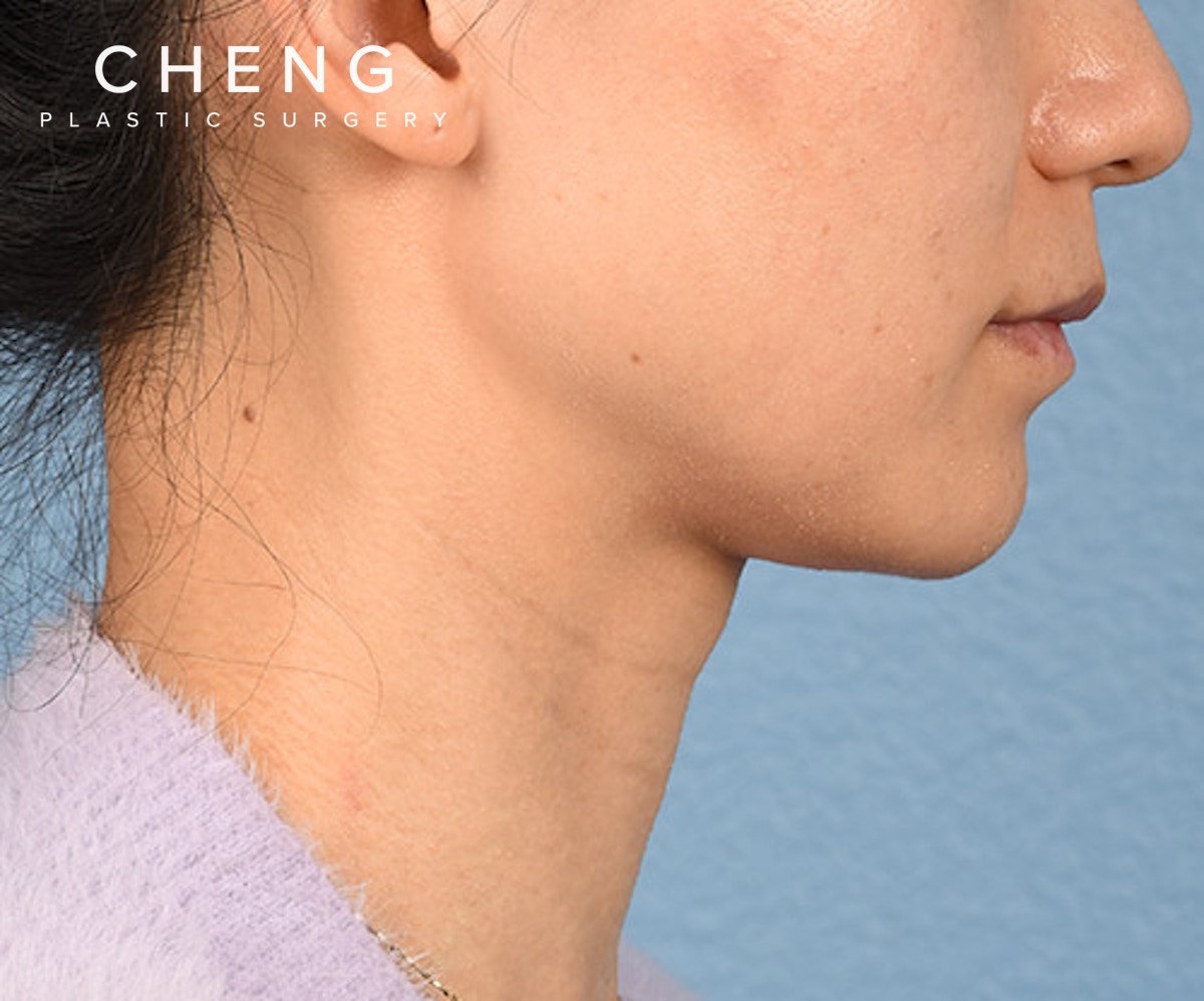 Hidden Patients Before & After Gallery - Patient 343443 - Image 5