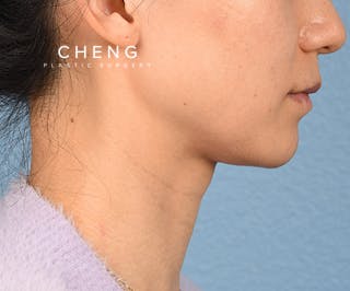 Hidden Patients Before & After Gallery - Patient 343443 - Image 5