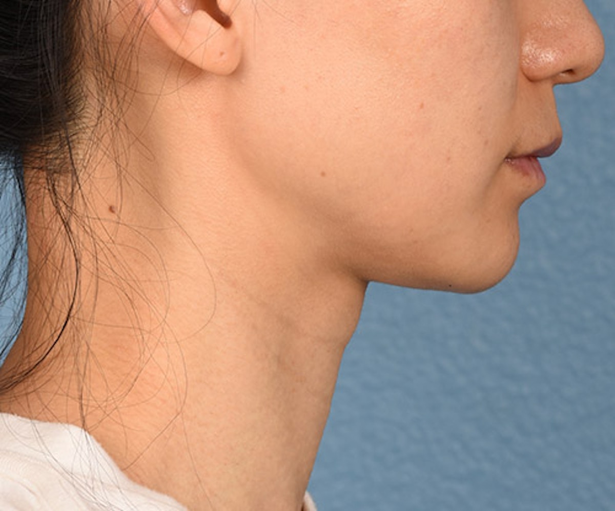 Thermage Flx Before & After Gallery - Patient 219720 - Image 6