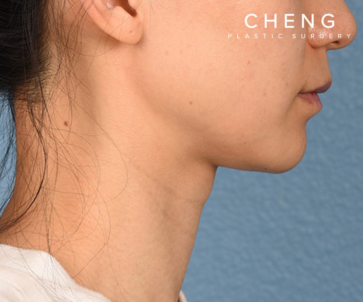 Hidden Patients Before & After Gallery - Patient 343443 - Image 6