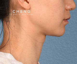 Hidden Patients Before & After Gallery - Patient 343443 - Image 6